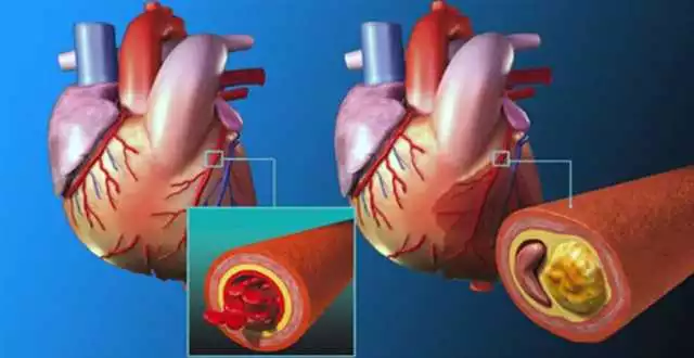 Ce Este Cardione Și Cum Funcționează?