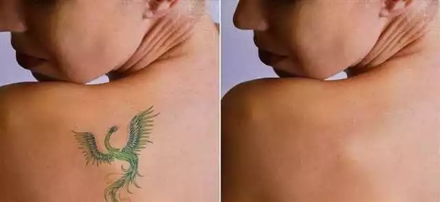 Removio în Timișoara — metoda modernă de îndepărtare a tatuajelor | Clinica specializată în eliminarea tatuaților